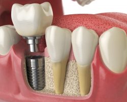 dental-implant-cerrahisi-sancar-simsek-1